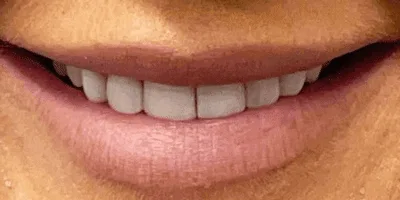 1-4.png tooth whitening - pearl dental surgery norwich