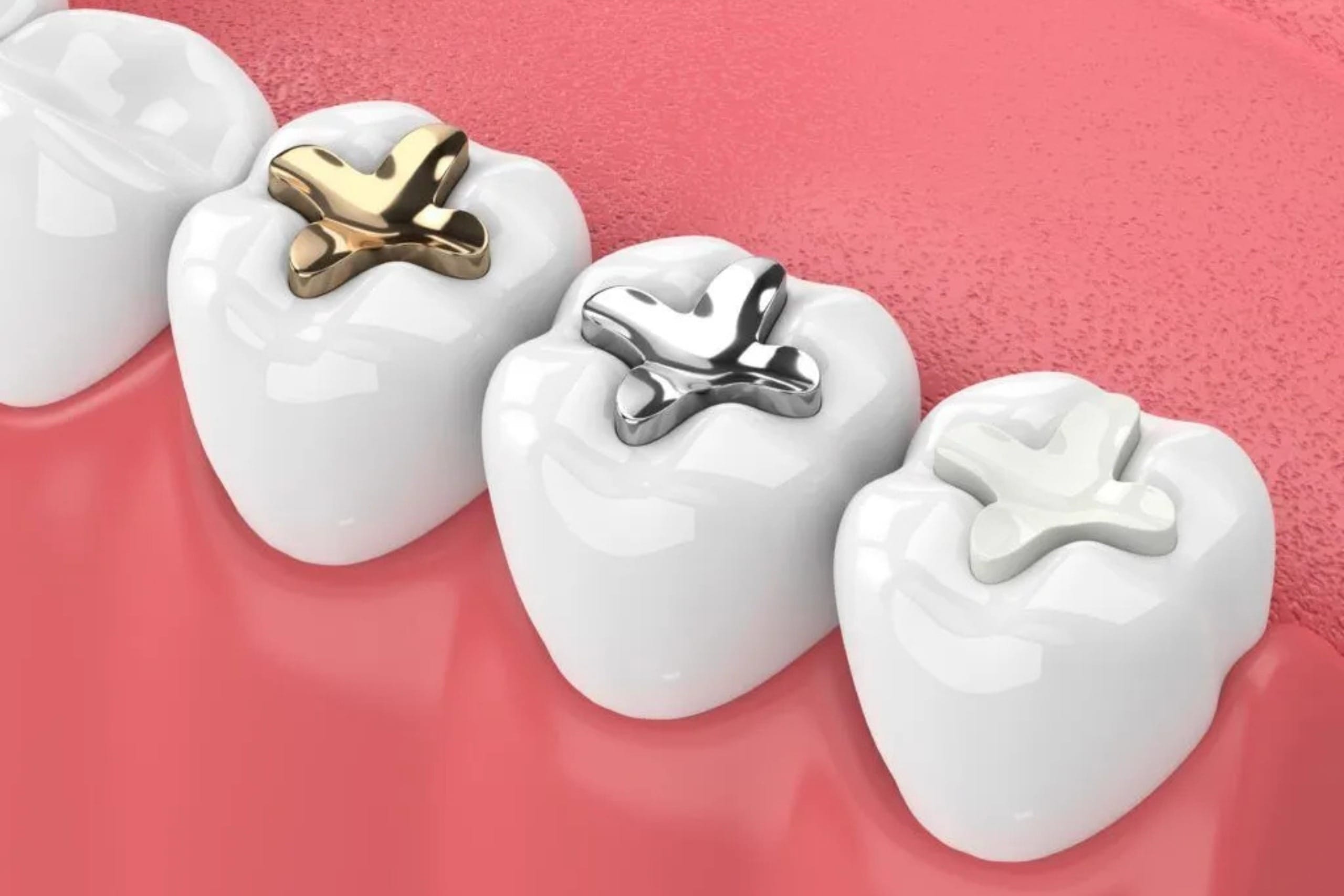 teeth filling - pearl dental surgery