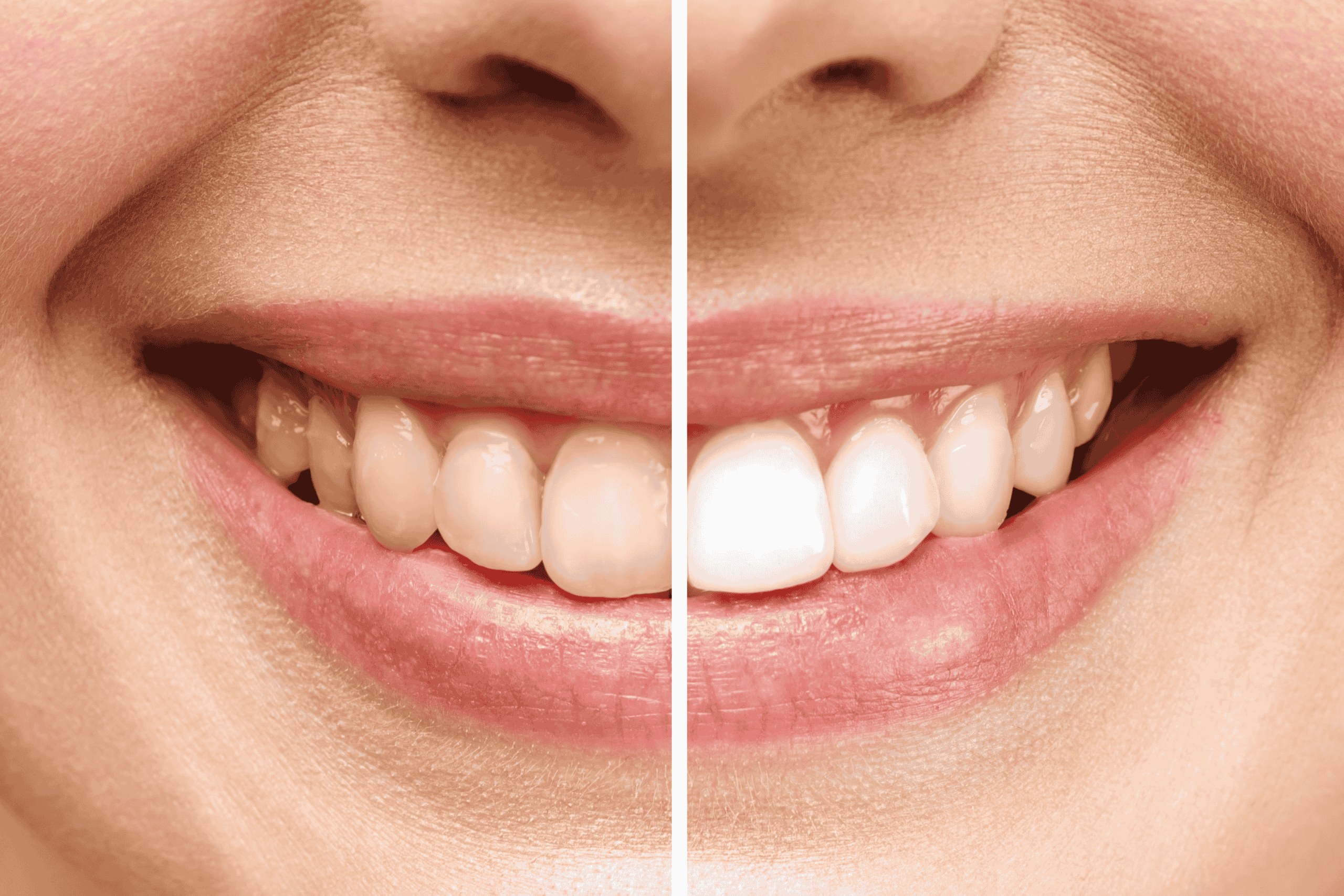 teeth whitening in norwich - pearl dental surgery