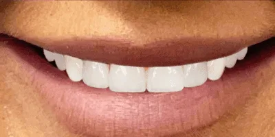 tooth whitening - pearl dental surgery
