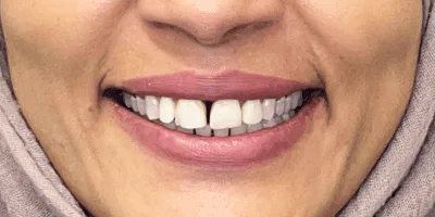 3-2.png cosmetic teeth - Pearl dental surgery