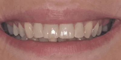 composite bonding - pearl dental surgery norwich