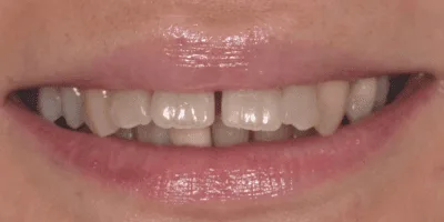 4-2.png composite bonding dentist