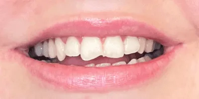 5-2.png cosmetic teeth - pearl dental surgery norwich