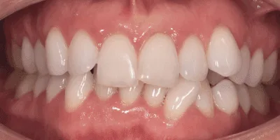 5-3.png invisalign in norwich - pearl dental surgery