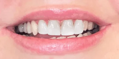 composite bonding dentist - pearl dental surgery norwich