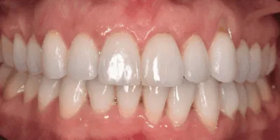 invisaligners - pearl dental surgery