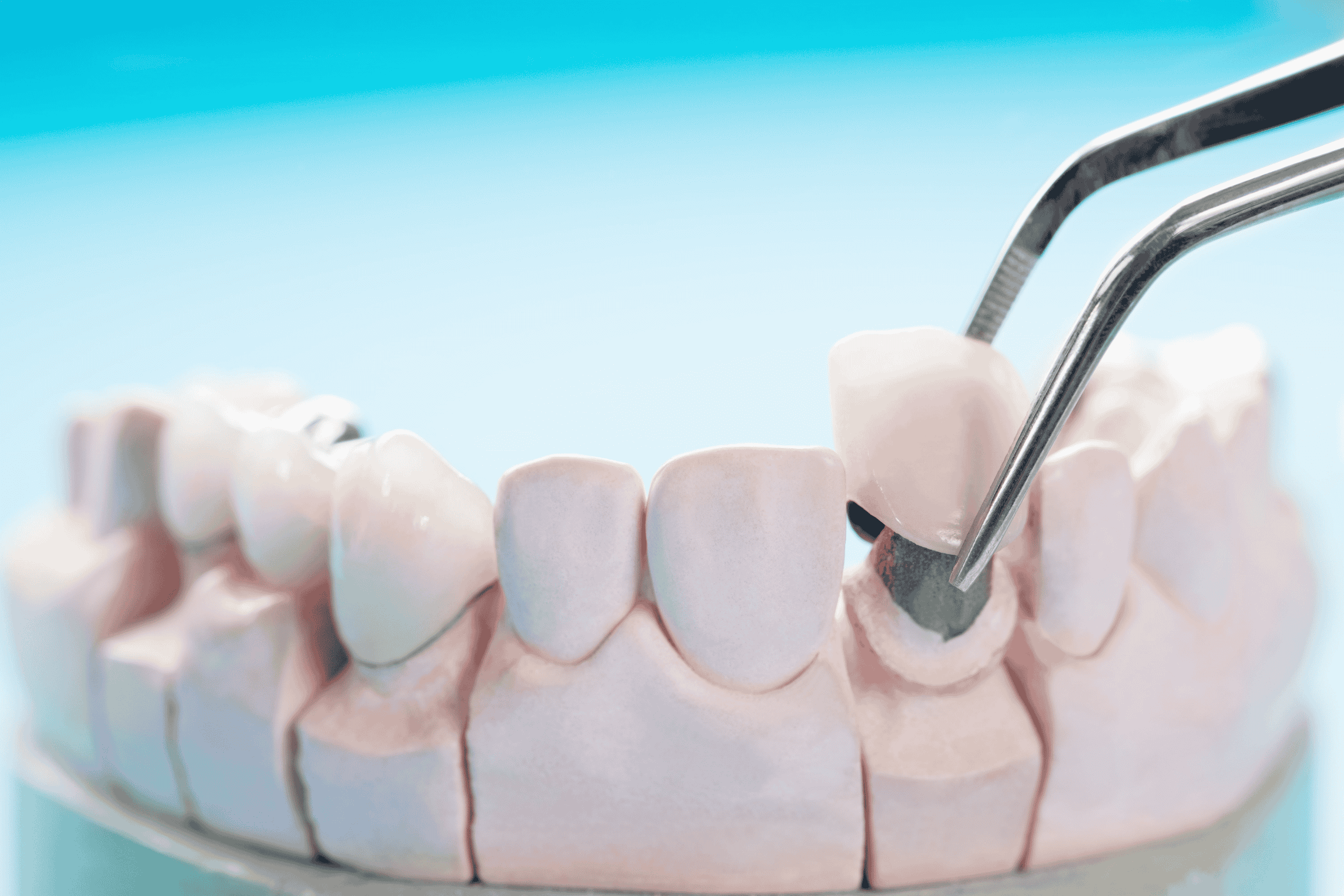 dental crown - Pearl dental surgery