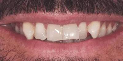 7-2.png aligners - pearl dental surgery norwich