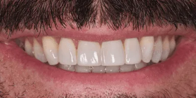 dental aligners - pearl dental surgery