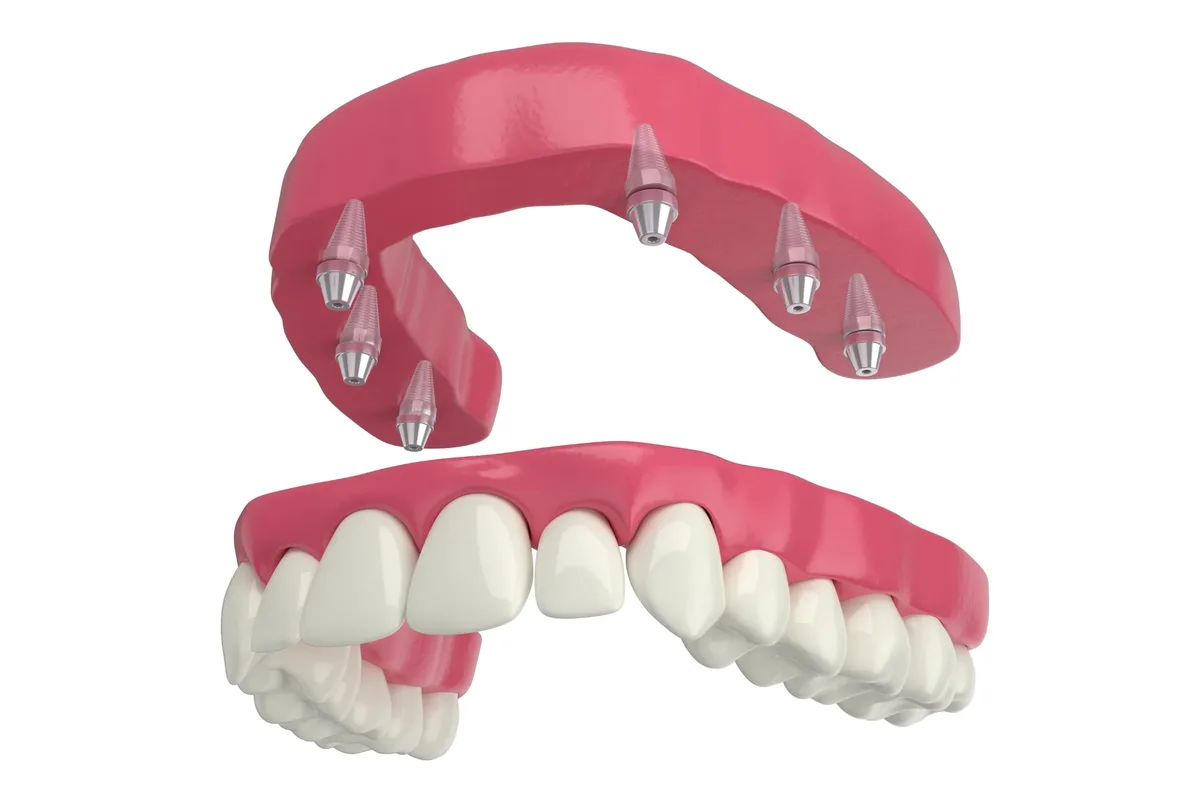 dentures - pearl dental surgery