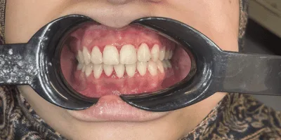 aligners - pearl dental surgery norwich