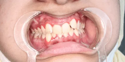 Untitled-design-25-1.png aligners - pearl dental surgery norwich
