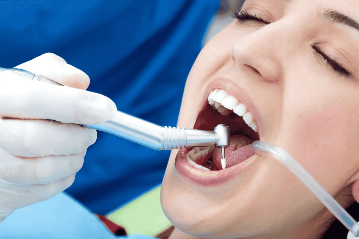 Everything You Need to Know About Dental Fillings at Pearl Dentals