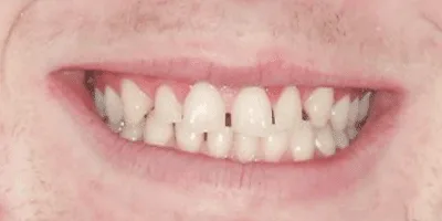 Untitled design (18) invisaligners - pearl dental surgery norwich