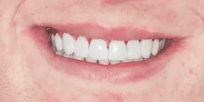 invisalign norwich - pearl dental surgery