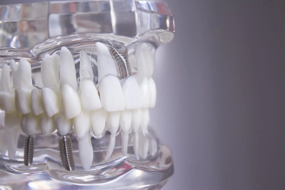 multiple dental implants