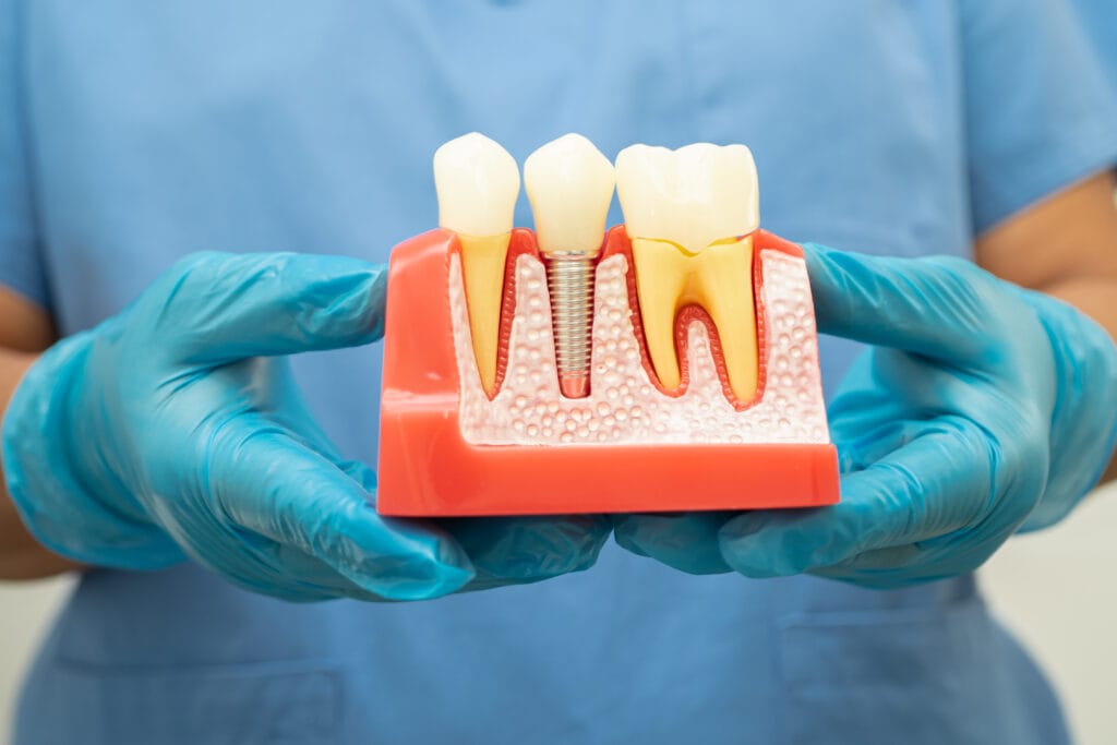 Immediate Dental Implants